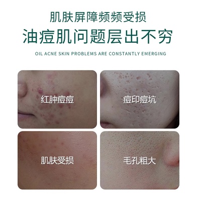 美容院专供祛痘套盒祛痘霜淡化痘坑印修护精华液不挂网护肤品套盒